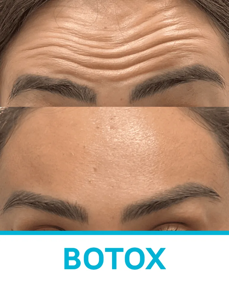 Toxina Botulínica (3 zonas)