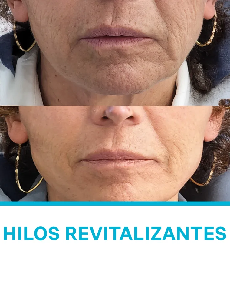 Hilos Revitalizantes