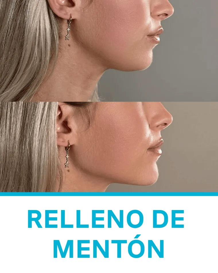 Relleno de Mentón
