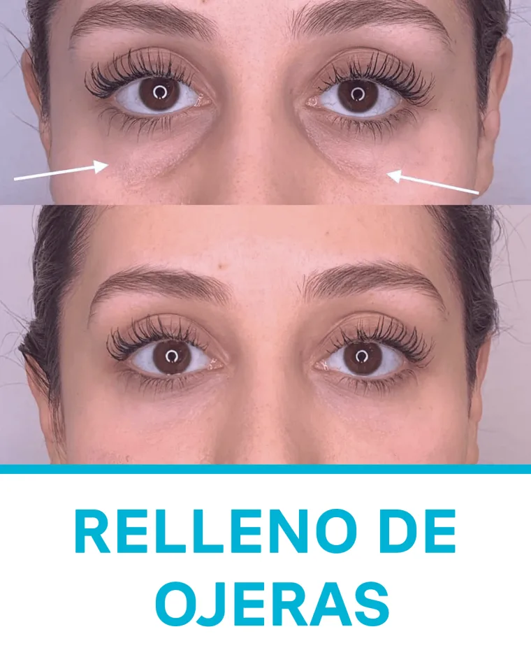 Relleno de Ojeras
